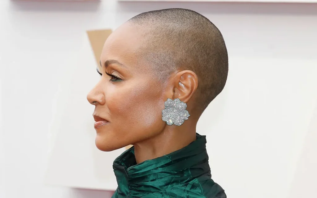 jada pinkett smith alopecia