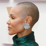 jada pinkett smith alopecia
